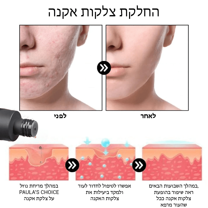 PoreClear™ 2% BHA נוזל לחידוש העור