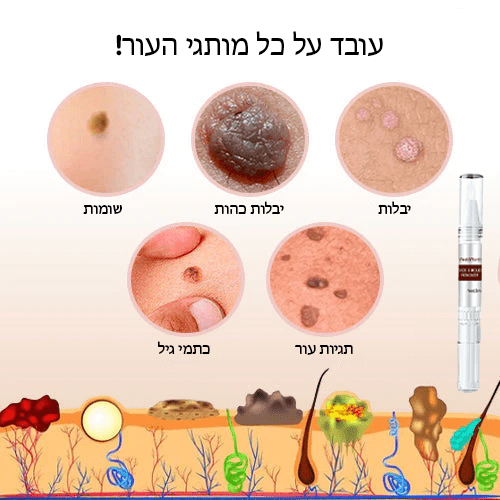 תגי SmoothTouch™ ומסיר שומות