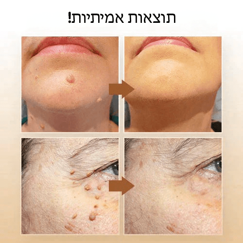 תגי SmoothTouch™ ומסיר שומות