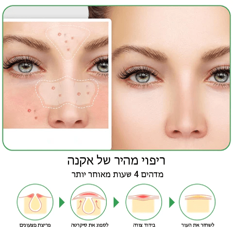 HydraClear™ מדבקות נקיות להידרוקולואיד אקנה ללילה