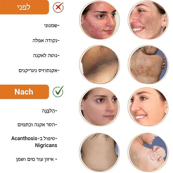 AcanthaClear™ תחליב ניקוי לאקנה וכתמים ואקנתוזיס ניגריקנים"