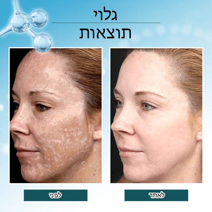 BrightSpot™ מסיר כתמים כהים מבהיר משולש פעיל