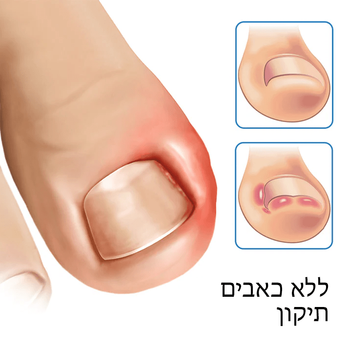 German ToenailHeal™ תיקון הפרוניכיה