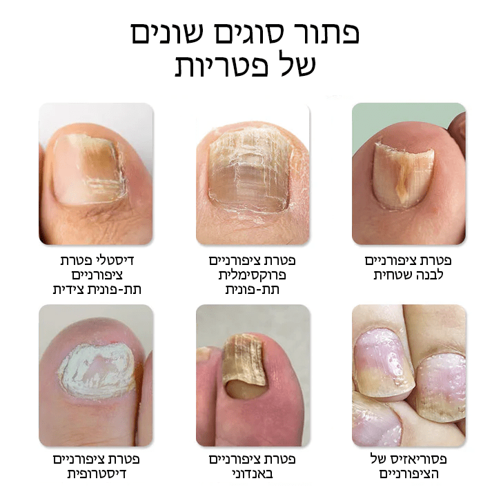 FungiFree™ מכשיר הקלה בלייזר לניקוי פטרת ציפורניים