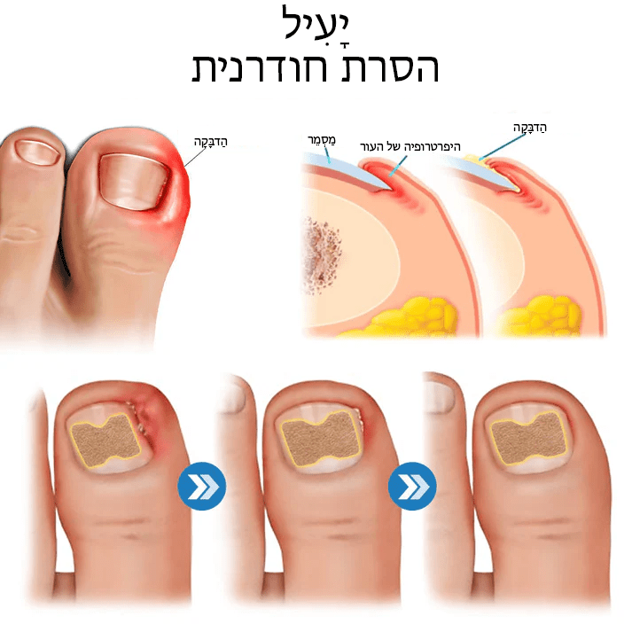 German ToenailHeal™ תיקון הפרוניכיה