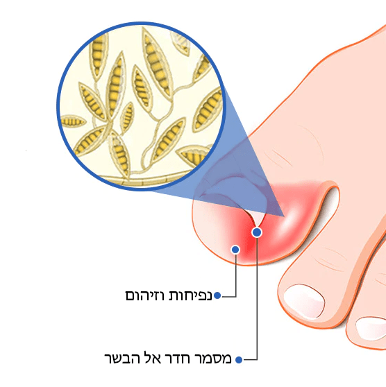 FungiFree™ מכשיר הקלה בלייזר לניקוי פטרת ציפורניים