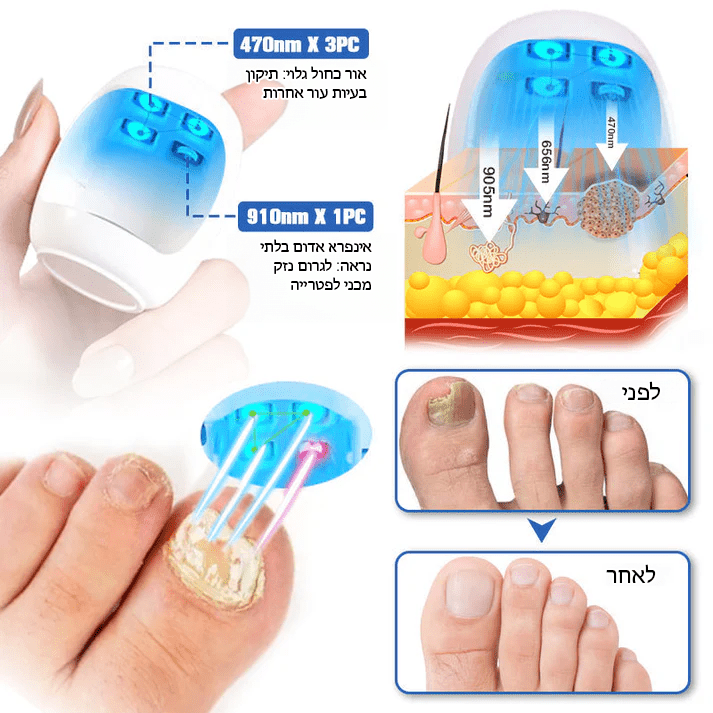 FungiFree™ מכשיר הקלה בלייזר לניקוי פטרת ציפורניים