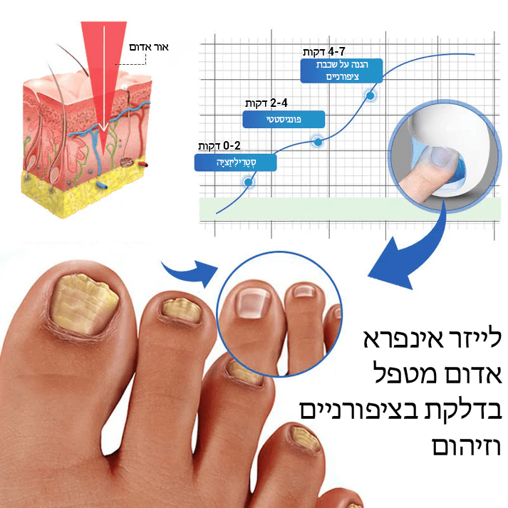 FungiFree™ מכשיר הקלה בלייזר לניקוי פטרת ציפורניים