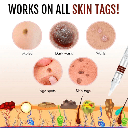 WipeOff™ removes tags and moles